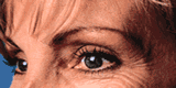Mimické vrásky oko očí - BOTOX